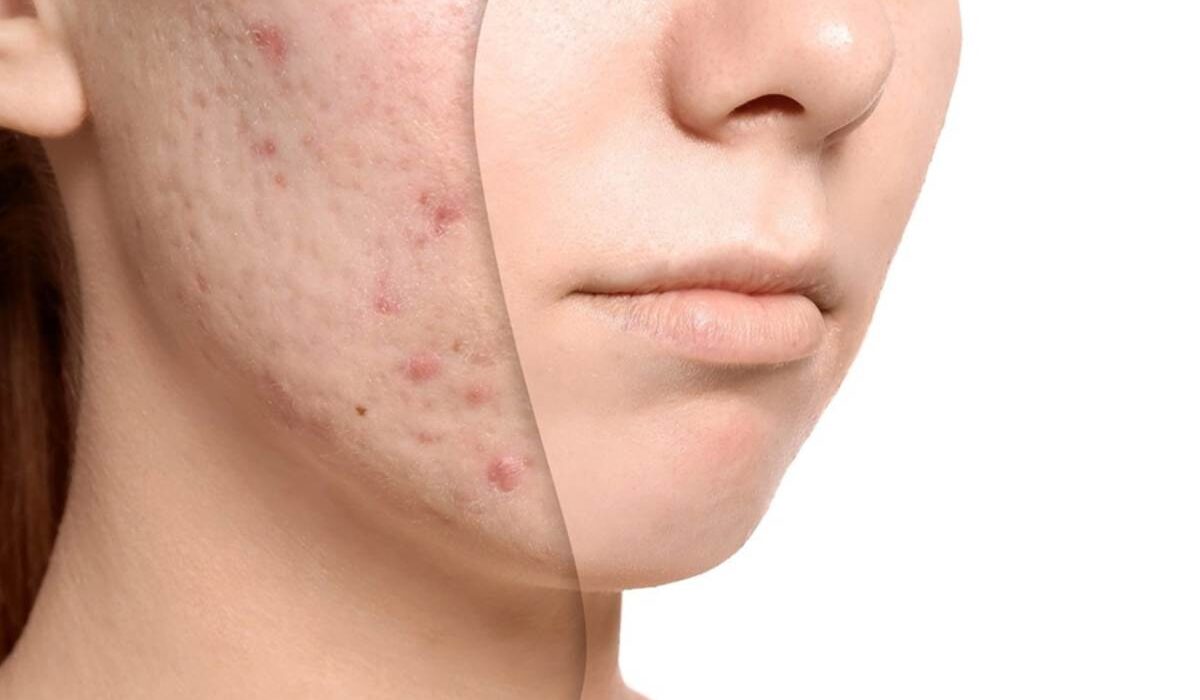 Acne Oil Treatment: The Natural Way to Clear Your Skin
