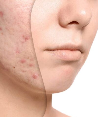 Acne Oil Treatment: The Natural Way to Clear Your Skin