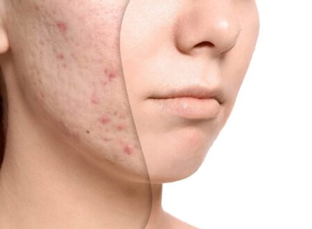 Acne Oil Treatment: The Natural Way to Clear Your Skin