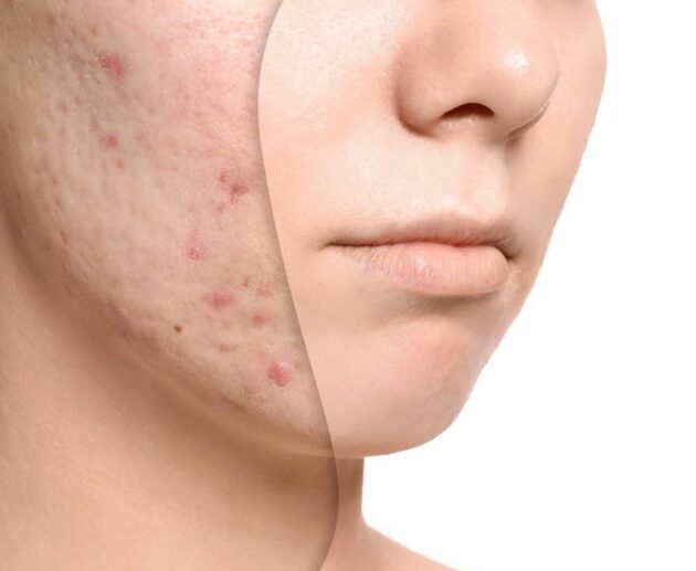 Acne Oil Treatment: The Natural Way to Clear Your Skin