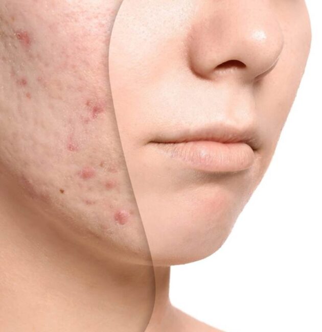 Acne Oil Treatment: The Natural Way to Clear Your Skin