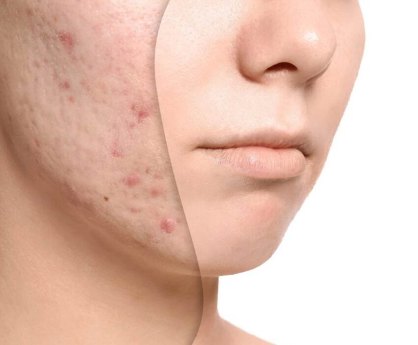 Acne Oil Treatment: The Natural Way to Clear Your Skin