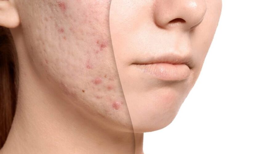 Acne Oil Treatment: The Natural Way to Clear Your Skin
