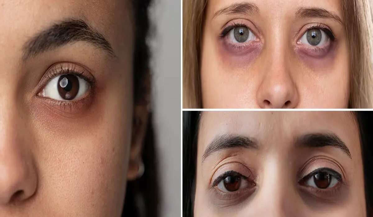 How To Remove Dark Circles Under Eyes Permanently