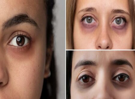 How To Remove Dark Circles Under Eyes Permanently