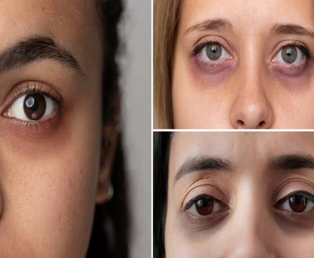 How To Remove Dark Circles Under Eyes Permanently