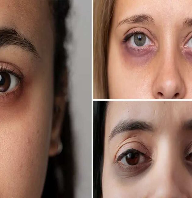 How To Remove Dark Circles Under Eyes Permanently