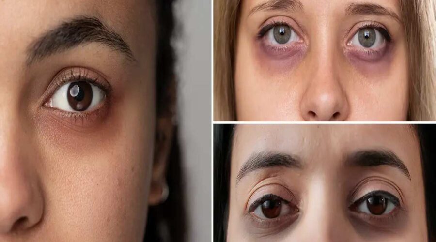 How To Remove Dark Circles Under Eyes Permanently